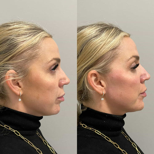 Botox Treatment for Frown Lines: Can Botox Improve Facial Expressions?