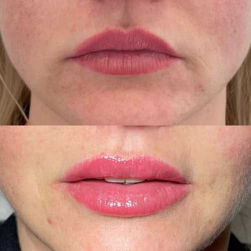 How Long Swelling After Tear Trough Filler