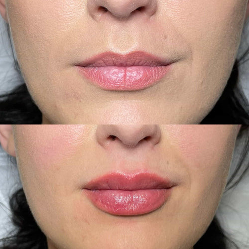 Do fillers work on 70 year olds?