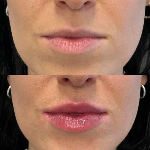 Do fillers work on 70 year olds?