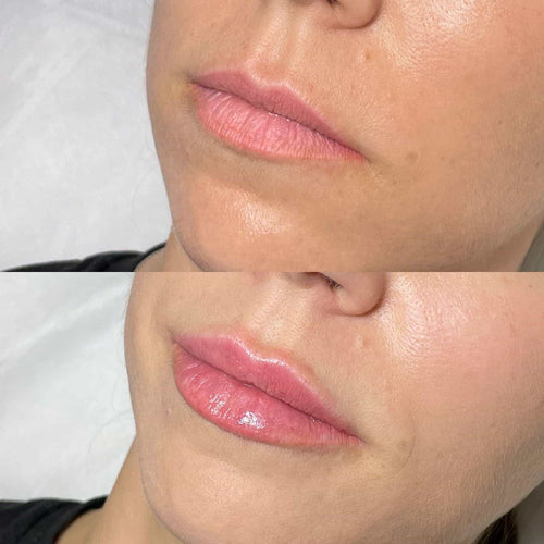 How To Reduce Lip Filler Swelling Overnight