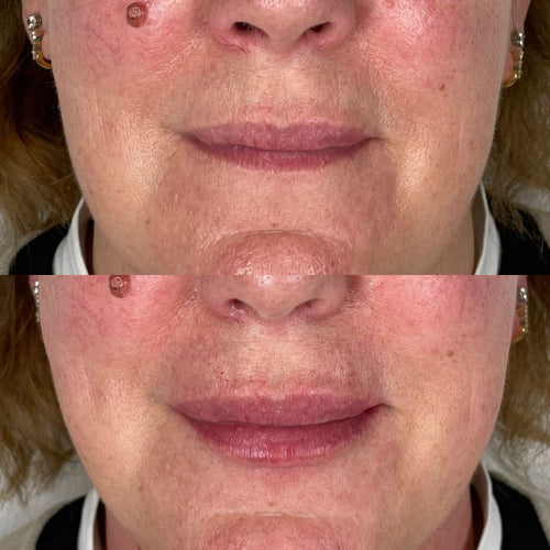 How Long Does Juvederm Lip Filler Last